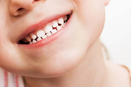 أسئلة شائعة حول تسوس الأسنان عند الأطفال | مشكلة تواجه كل أم !