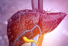 الدليل الكامل عن أعراض إنزيمات الكبد المرتفعة